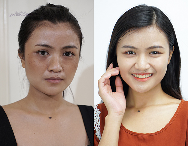 Bộ ảnh chứng minh sức tàn phá của nám với nhan sắc người phụ nữ - 5