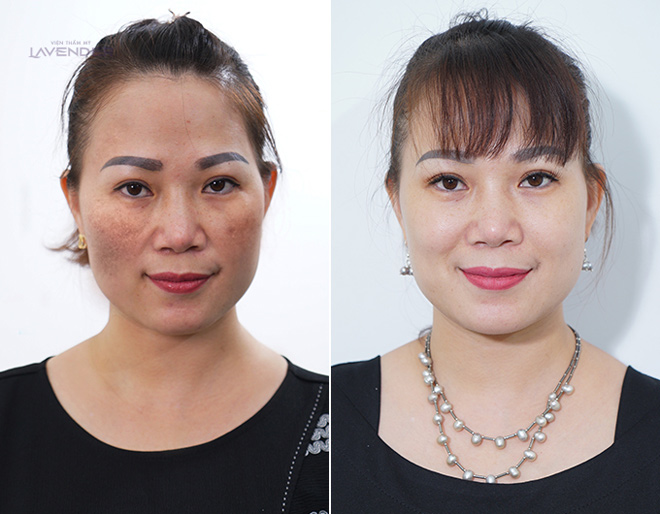 Bộ ảnh chứng minh sức tàn phá của nám với nhan sắc người phụ nữ - 6