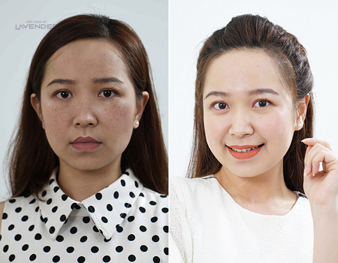 Bộ ảnh chứng minh sức tàn phá của nám với nhan sắc người phụ nữ - 7