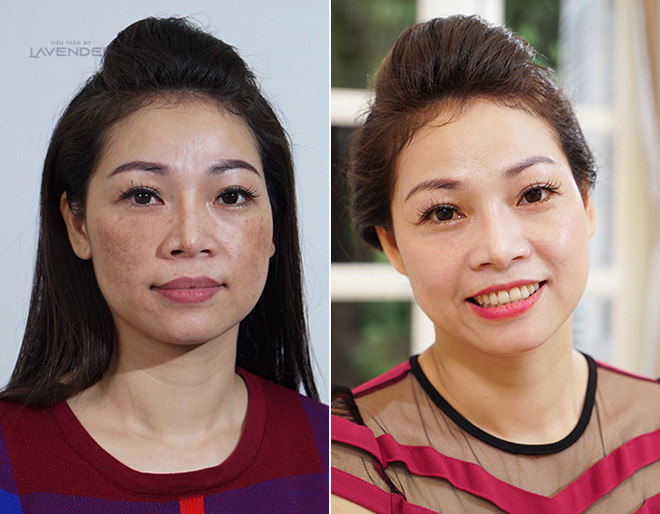 Bộ ảnh chứng minh sức tàn phá của nám với nhan sắc người phụ nữ - 8