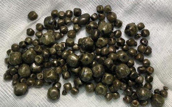 Người phụ nữ mang gần 300 viên sỏi túi mật suốt 10 năm - 1