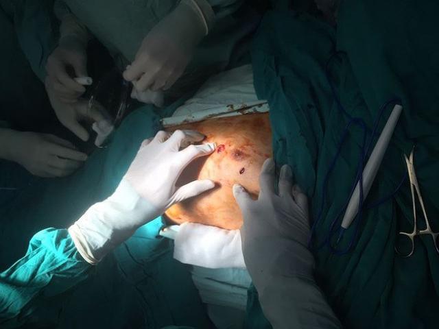 Sức khỏe đời sống - Chờ mổ chân, nam bệnh nhân tự dùng kéo... đâm thủng tim