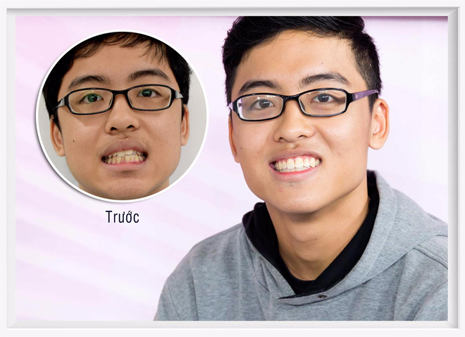 Nam sinh trường Quốc tế “đổi sắc” nhờ niềng răng - 5