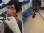 Phi thường - kỳ quặc - Kinh hãi đỉa sống trong mũi người đàn ông ở Việt Nam