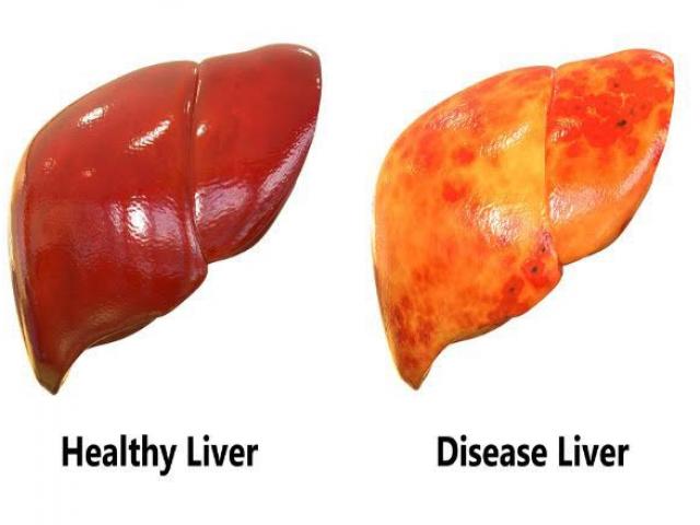Sức khỏe đời sống - Bệnh nhân xơ gan nên ăn và nên tránh thực phẩm gì