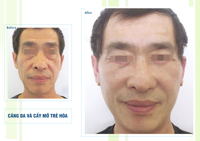 200 cơ hội điều trị mụn, nám miễn phí cho chị em nào nhanh tay - 3