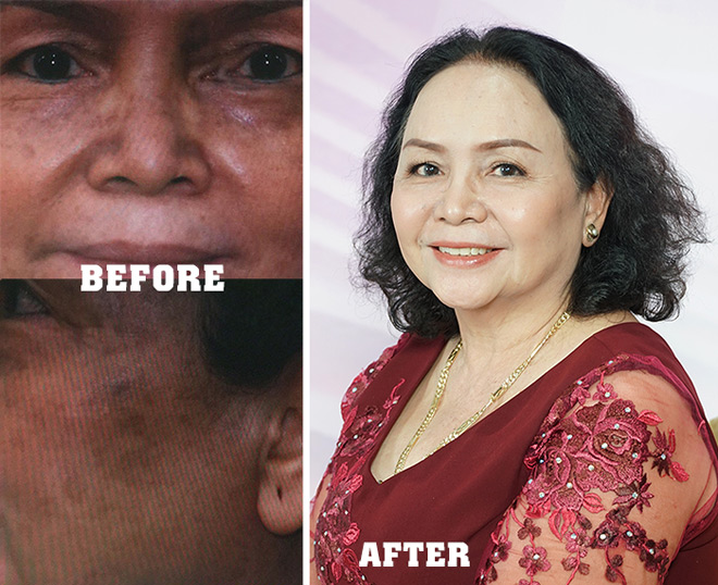 Làn da xấu xí vì trị nám sai cách, may mà có cách cứu vãn - 1