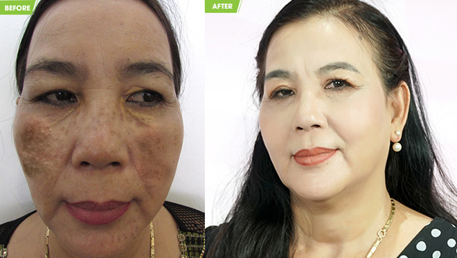 Làn da xấu xí vì trị nám sai cách, may mà có cách cứu vãn - 2