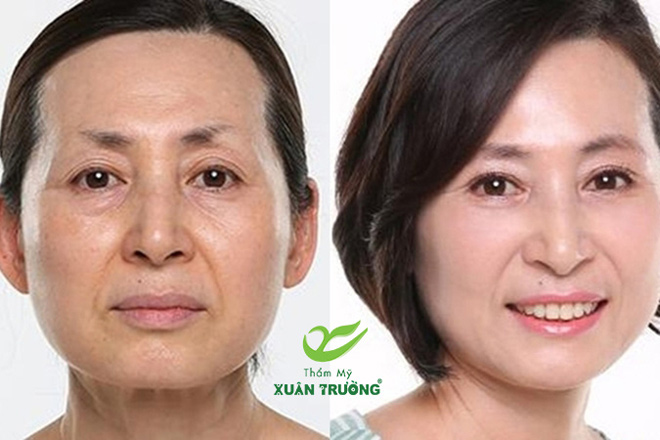 Căng da bằng chỉ “hút khách” là vì những lý do này - 3