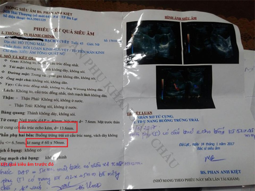 U nang lớn kèm nhân xơ, người phụ nữ như gặp được “cứu tinh” khi dùng sản phẩm này - 2