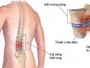 Thoát vị đĩa đệm và các quan niệm sai lầm