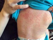 Sức khỏe đời sống - Món ăn, nước uống giúp đẩy lùi bệnh sởi