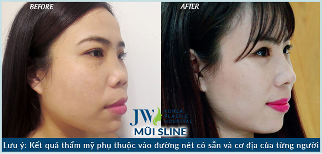 Bác sĩ Hàn Quốc hỗ trợ 100% chi phí PTTM ca mũi khó - 3