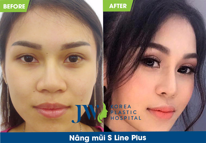 Bác sĩ Hàn Quốc hỗ trợ 100% chi phí PTTM ca mũi khó - 4