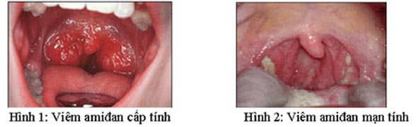 Bài thuốc chữa viêm amidan mạn tính - 1