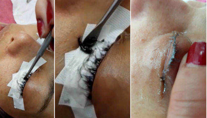 Ham rẻ, cô gái Thái Lan suýt hỏng mắt vì nối mi bằng keo dán sắt - 3