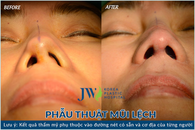 Nổi bật những ca mũi khó được giải cứu 2018 - 4