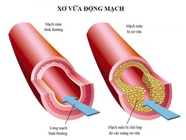 Giải pháp mới cho người xơ vữa động mạch từ Nhật Bản - 1