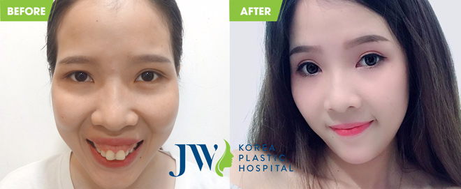 Những khuôn mặt kém duyên thay đổi ngoạn mục sau khi hết hô, móm - 2