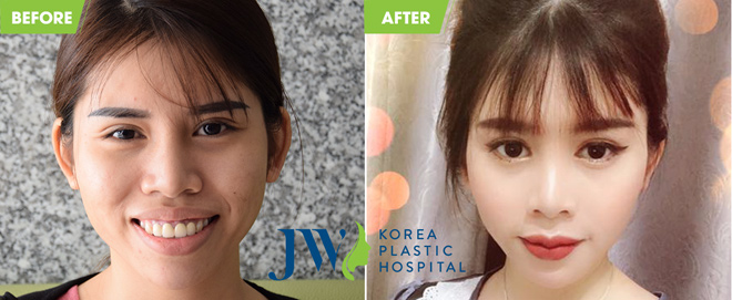 Những khuôn mặt kém duyên thay đổi ngoạn mục sau khi hết hô, móm - 3