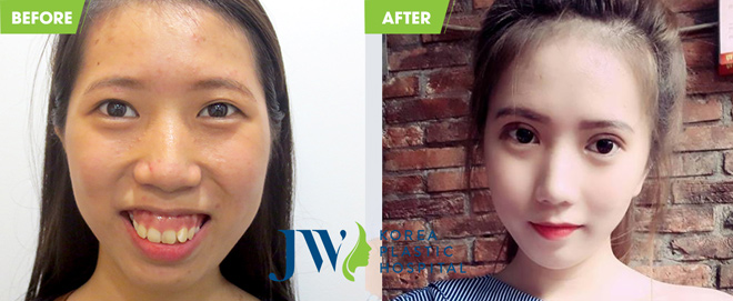 Những khuôn mặt kém duyên thay đổi ngoạn mục sau khi hết hô, móm - 4