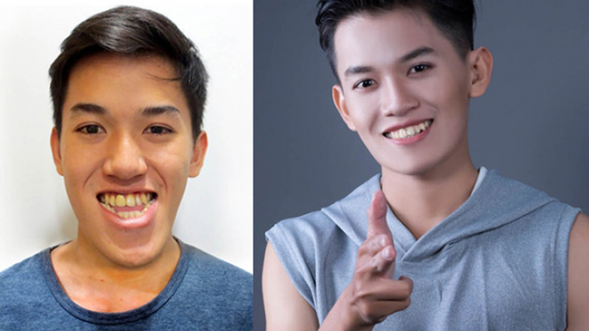 Những khuôn mặt kém duyên thay đổi ngoạn mục sau khi hết hô, móm - 5