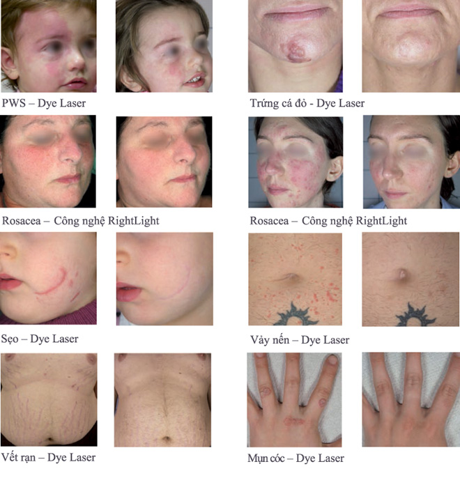 Synchro VasQ - Giải pháp hiệu quả nhất trong điều trị bệnh lý mạch máu - 4