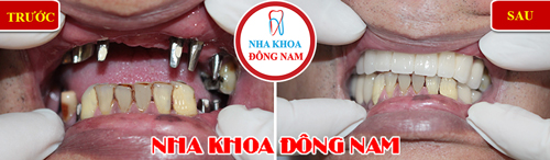 Cấy răng Implant với công nghệ CT 3D mới, chuẩn xác từng milimet - 3