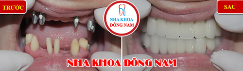 Cấy răng Implant với công nghệ CT 3D mới, chuẩn xác từng milimet - 4