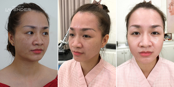 Trị nám bằng laser: Công nghệ chiếm 50%, còn lại phụ thuộc vào bác sĩ - 3