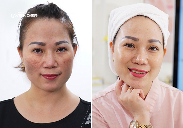 Trị nám bằng laser: Công nghệ chiếm 50%, còn lại phụ thuộc vào bác sĩ - 4