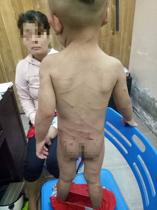 Đã có kết luận thương tích bé trai bị cha dượng đánh dã man ở Phú Quốc - 2