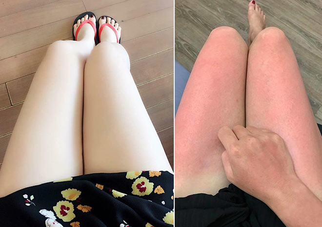 Hết mùa du lịch, chị em đua nhau tìm cách phục hồi da cháy nắng - 4