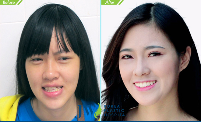 JW hỗ trợ chi phí phẫu thuật, niềng răng cho người bị hô móm - 4