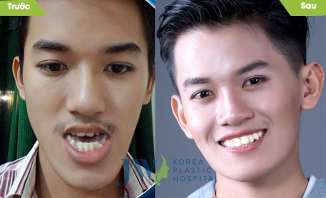 JW hỗ trợ chi phí phẫu thuật, niềng răng cho người bị hô móm - 5