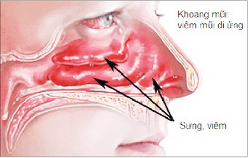 Bài mẫu 5: Sử dụng liệu pháp thiên nhiên trong điều trị viêm mũi dị ứng