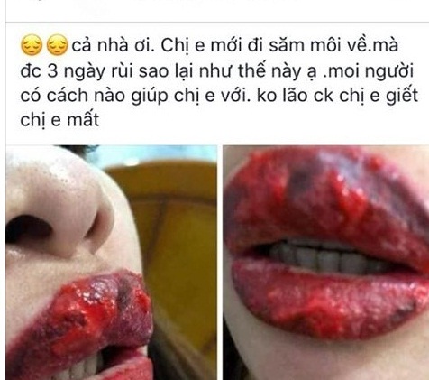 Xăm môi, nhấn mí tại nhà đừng “gửi trứng cho ác” - 1