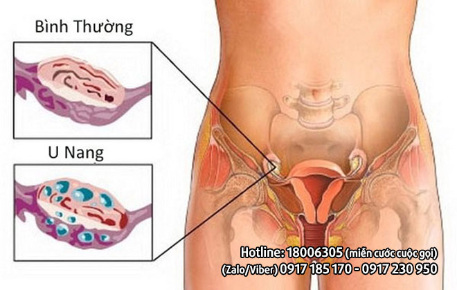 Bụng to như bụng bầu - Cẩn trọng với u nang buồng trứng - 1