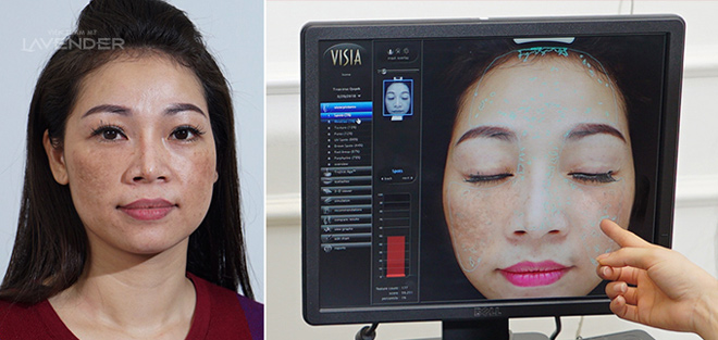 Trị nám bằng laser: Muốn nám mờ đi mỗi ngày cần biết các nguyên tắc sau - 3