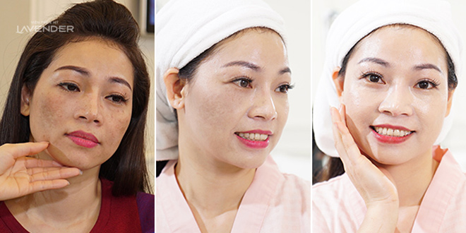 Trị nám bằng laser: Muốn nám mờ đi mỗi ngày cần biết các nguyên tắc sau - 4