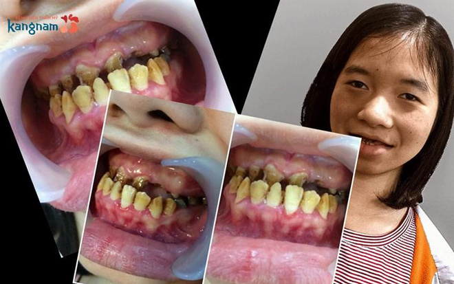Chuyên gia nhận định về ca phẫu thuật của cô gái “ma cà rồng” Phạm Thị Hà - 1