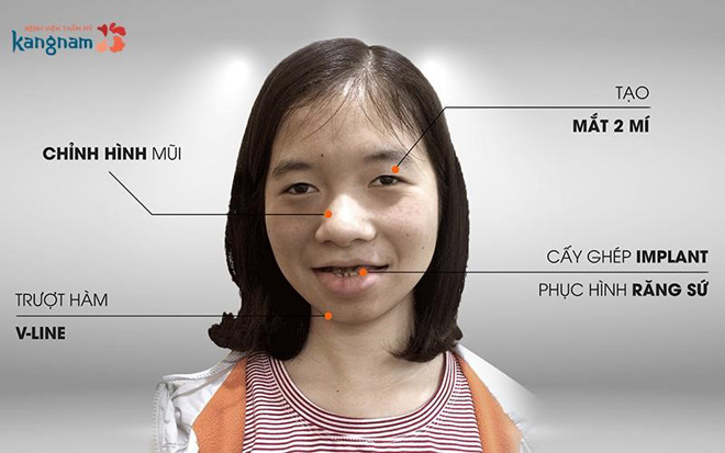 Chuyên gia nhận định về ca phẫu thuật của cô gái “ma cà rồng” Phạm Thị Hà - 5