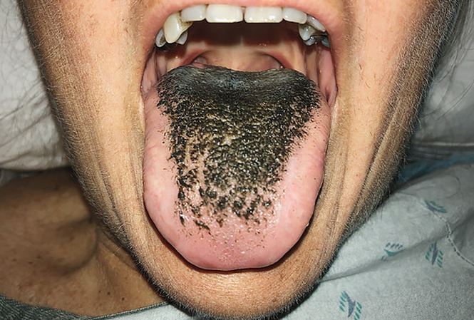 Mỹ: Kỳ lạ người phụ nữ mọc lông đen xì ở lưỡi - 1