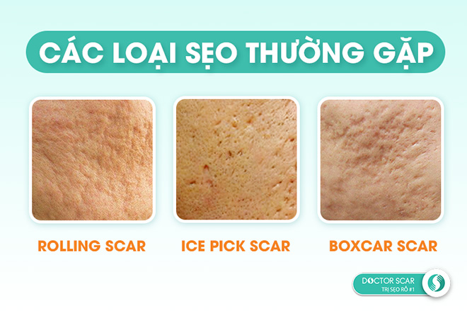 Trị mụn khó 1, trị sẹo rỗ khó 10 - 2