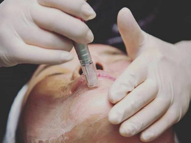 Thẩm mỹ viện - Cấy phấn cho da – kiểu "thí nghiệm chuột bạch" mạo hiểm