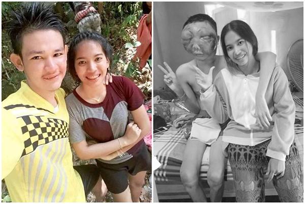 Chuyện tình cô gái và chàng trai bị biến dạng mặt vì ung thư mắt - 1