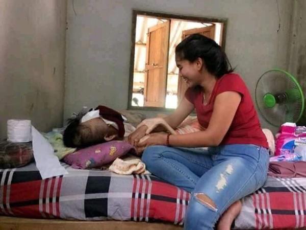 Chuyện tình cô gái và chàng trai bị biến dạng mặt vì ung thư mắt - 4