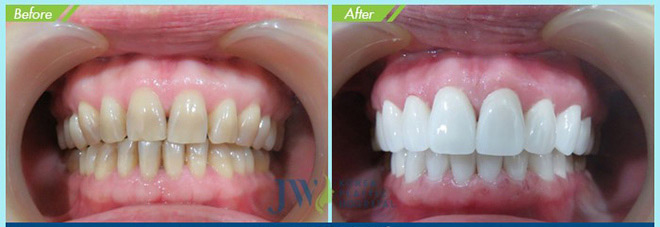 HOT: Bọc răng sứ không mài răng với giá chỉ 1.000đ! - 7