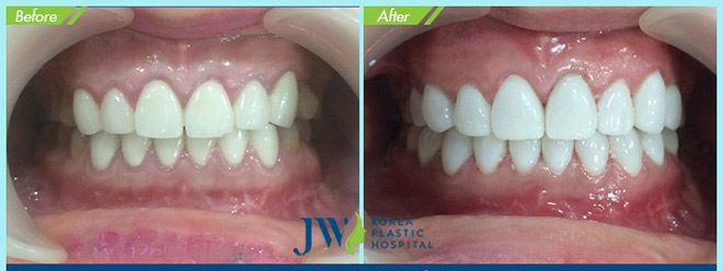 HOT: Bọc răng sứ không mài răng với giá chỉ 1.000đ! - 8