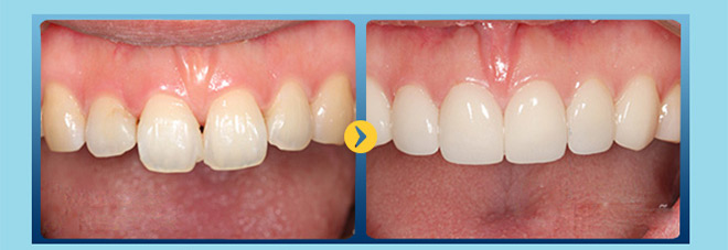 HOT: Bọc răng sứ không mài răng với giá chỉ 1.000đ! - 9